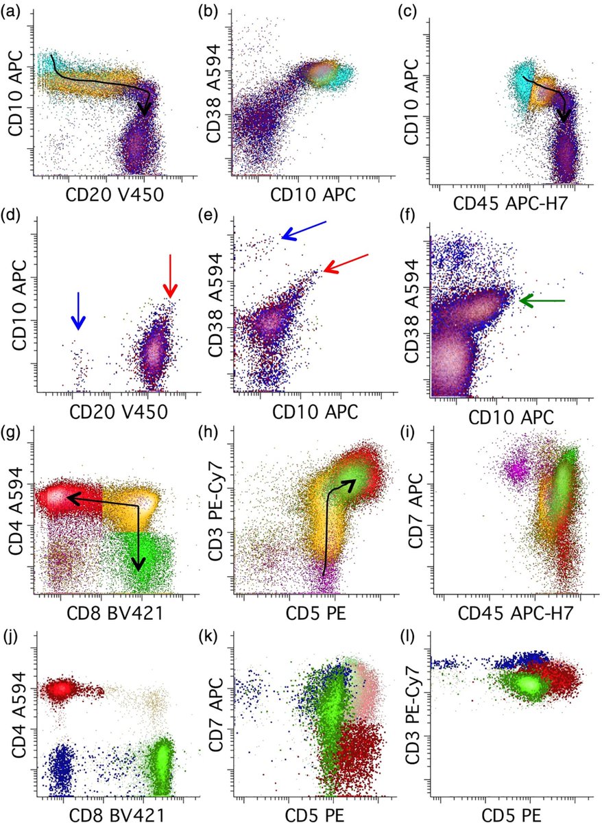 Just published: "Common flow cytometry pitfalls in diagnostic hematopathology" by Sindhu Cherian, Ben Hedley &amp; <a href="/MikeKeeney11/">Mike Keeney</a>, in the ICCS journal Clinical Cytometry. 

An outstanding article—a must-read for anyone interested in #hemepath &amp; #Flowcytometry! 
doi.org/10.1002/cyto.b…