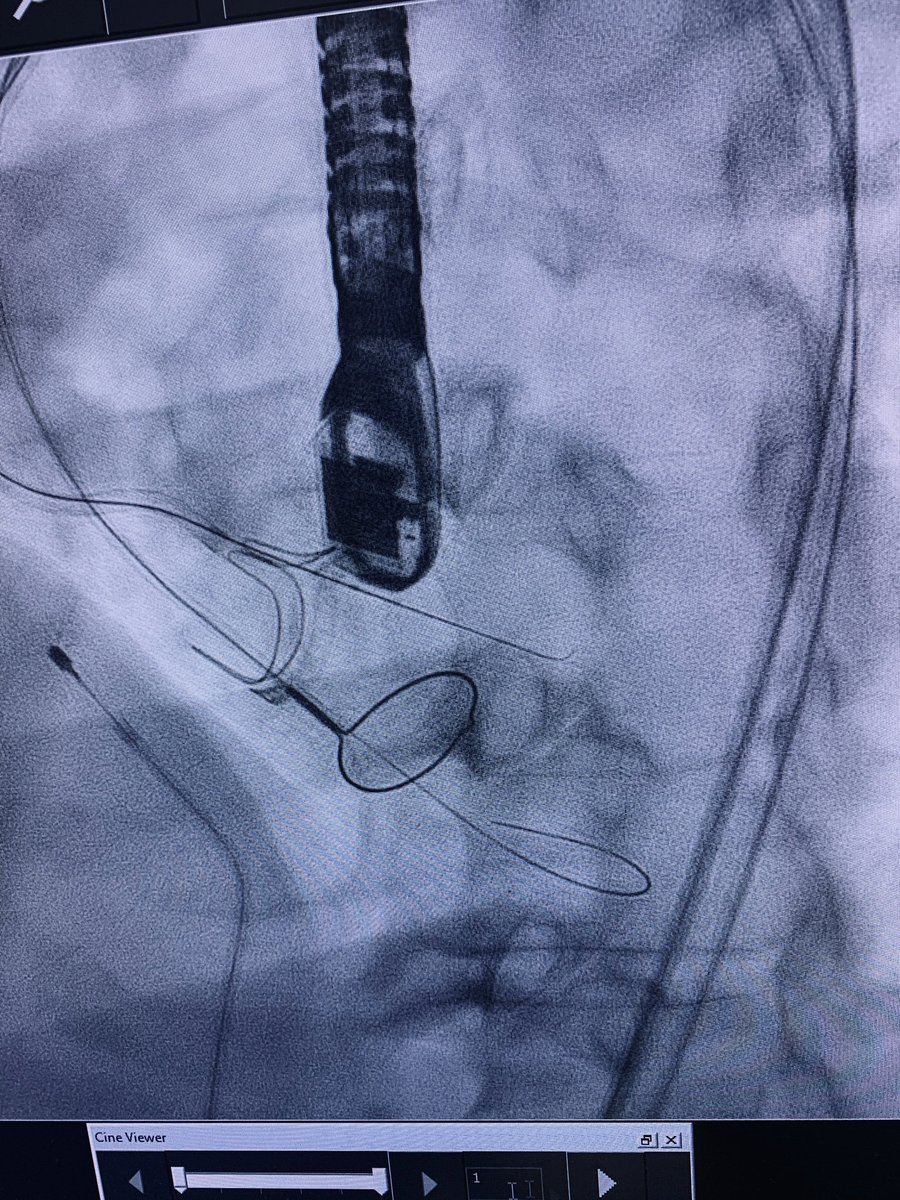 PaulMahoneyMD's tweet image. Held Sentara TAVR Advanced Course today: performed #basilica with #BVF in valve-in-valve  and two #transcaval live cases - great turnout; great audience.  

Thanks to all who came.

#TAVR 
@Medtronic 
@sentarahealth 
@SMGDoctors