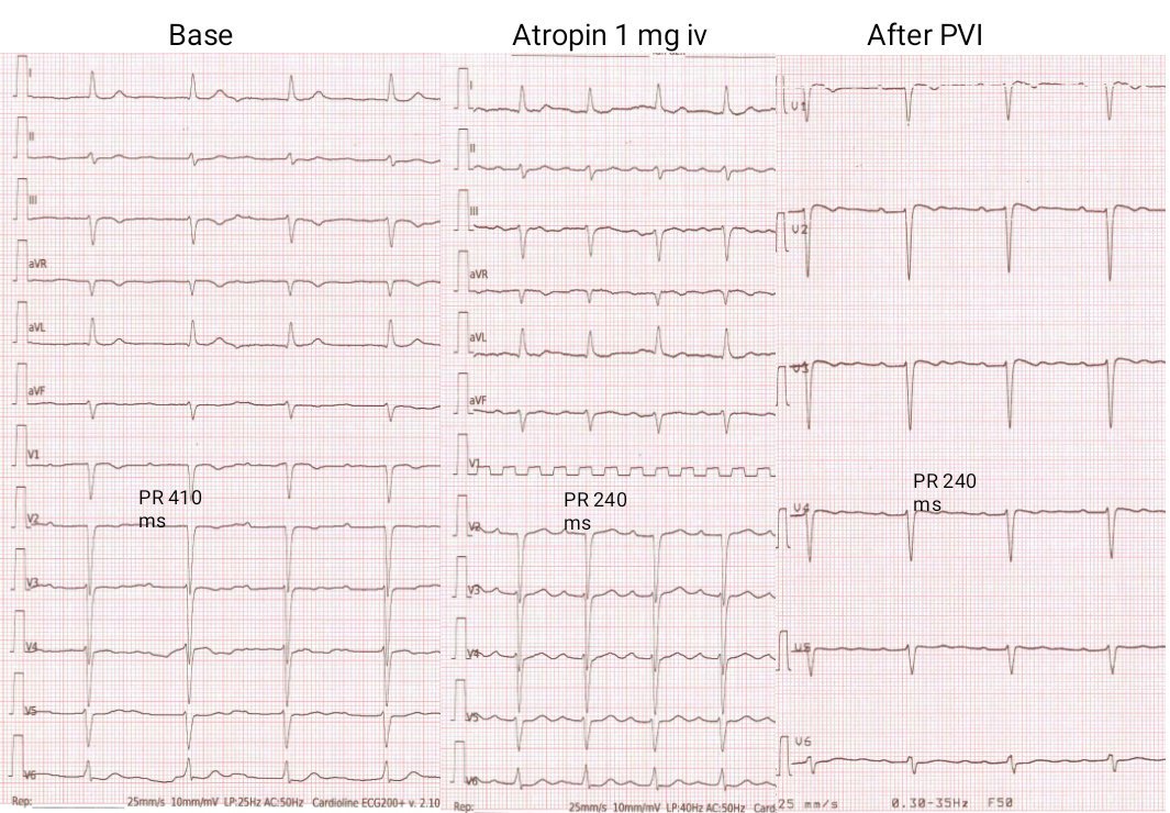 PietroRossiEP's tweet photo. Stable PR interval reduction after PVI. Is first degree AV block a marker of high parasympathetic tone in patient with paroxysmal AF?@stefbianchi @FilippoCauti @glumia @MDTolgaAksu @luigiaia https://t.co/CgjjV3Vb8L