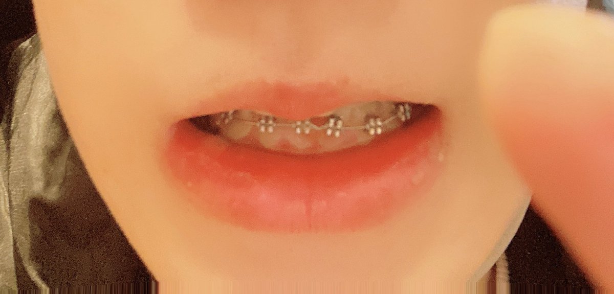 kaba_031's tweet photo. 私ごとですが、

上の歯は今年の5月からしてたのですが、

下の歯も昨日より
本格的に矯正を始めました
（もっと若いうちにしておけばよかった）
あと3年くらいこんな感じですが。。。

てことなので、喋った時に
びっくりしないでくださいね

てゆう報告でした https://t.co/47sHnqfoo6