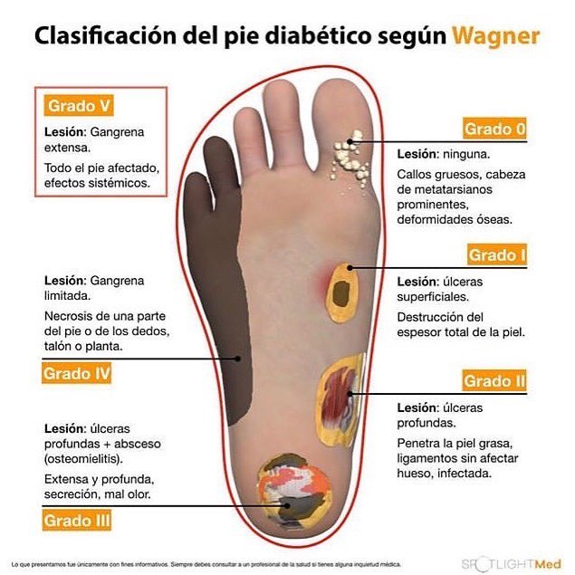 SVINFECTOLOGIA on Twitter "PIE DIABÉTICO . Diabetes mellitus no tratada adecuadamente, o de