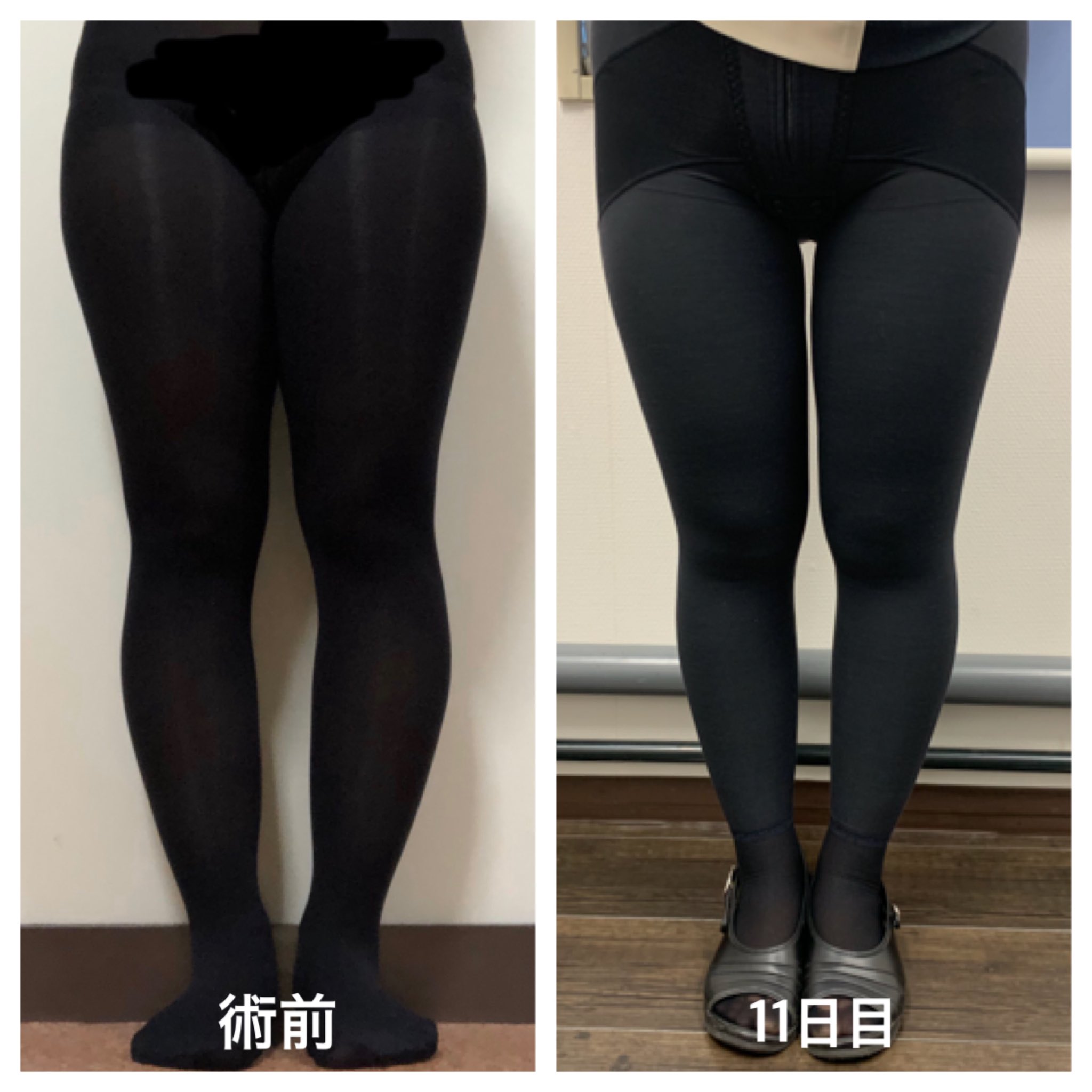 人気ブランドの アミュレット 脂肪吸引 着圧タイツ 湘南美容外科 SBC