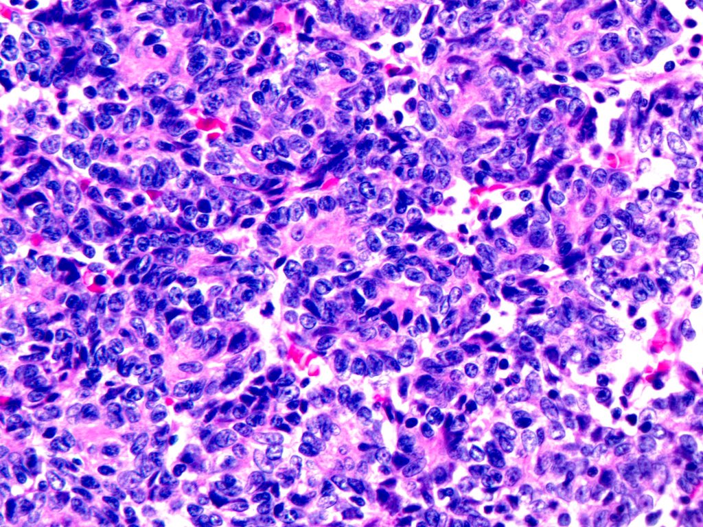smlungpathguy's tweet photo. O brave and wise Tweeples, would you like to try your luck, test your diagnostic eye, and deploy your wisdom on a “no history” case?
#pathology https://t.co/a7e7hln6rH