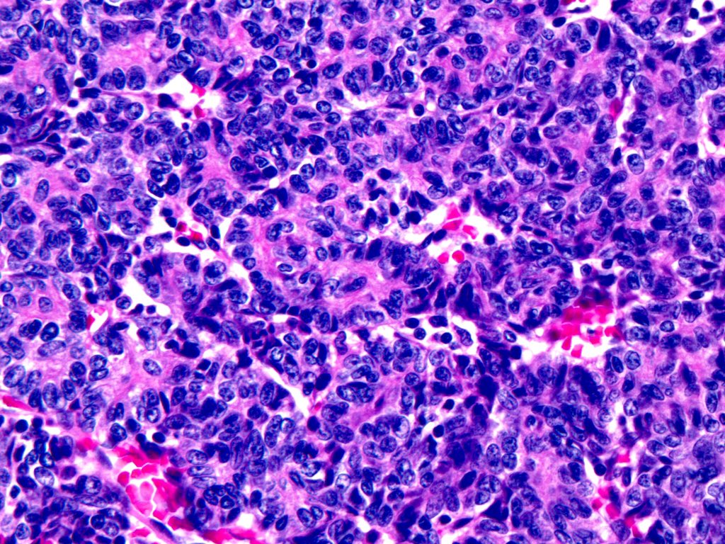 smlungpathguy's tweet photo. O brave and wise Tweeples, would you like to try your luck, test your diagnostic eye, and deploy your wisdom on a “no history” case?
#pathology https://t.co/a7e7hln6rH