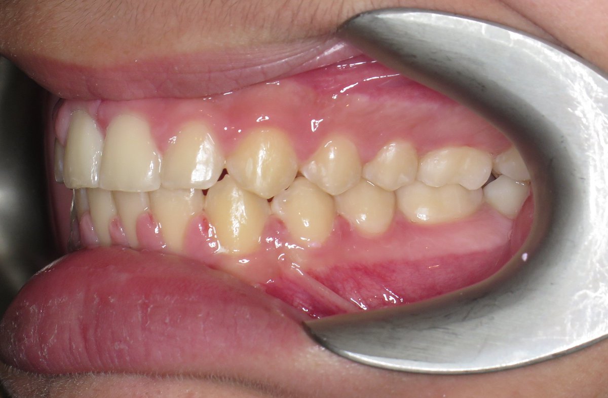 NorthendenHouse's tweet photo. Giving patients #perfectsmiles is what we do best and you can see it from this before and after.

Call us today on 0161 884 1481 📞 for help on starting your #bracetreatment.

#orthodontics #orthodontist #braces #teeth #smilemore #smiles #bracesjourney https://t.co/r42KSEMFHo