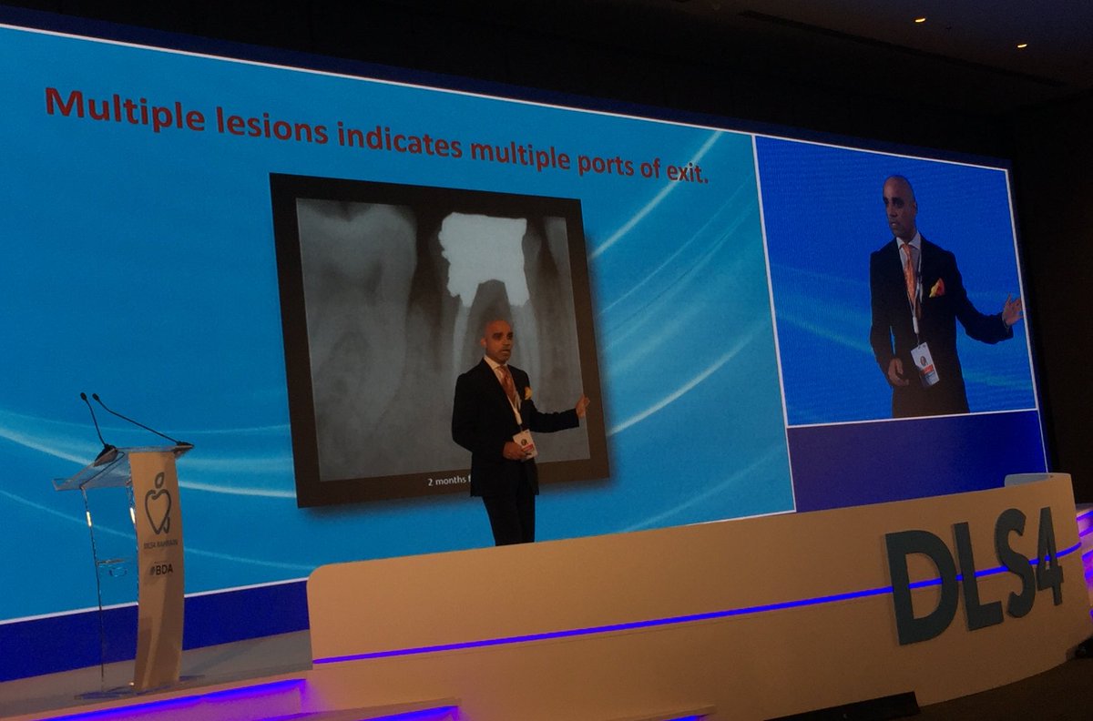 BDAcenter's tweet photo. Consideration and Indications for Endodontic Surgery lecture by Aqeel Al-Mosawi
#DLS4 #Dentist #life #experience #SaudiArabia #Saudianimeexpo #Bahrain #ุงูุจุญุฑูู #ุงูุณุนูุฏูุฉ #ุงููููุช #ุงูุฃุฑุฏู #ูุจูุงู https://t.co/WIcWH0Gbqz
