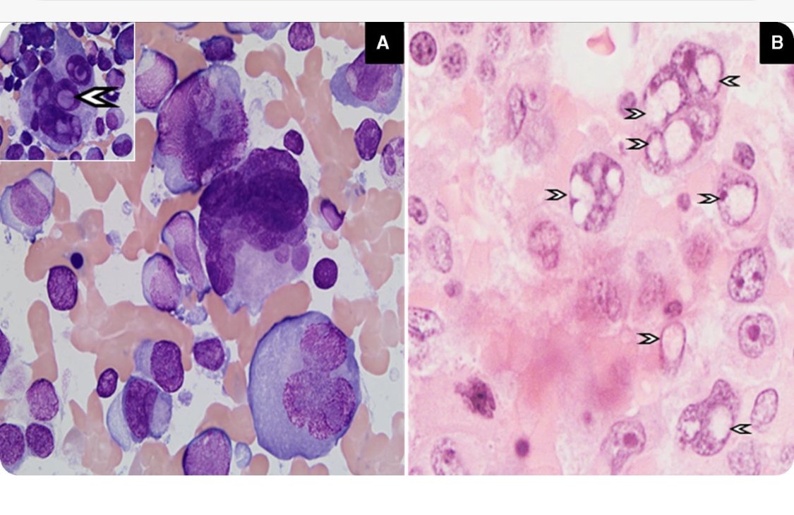 ?Megas ?Osteoclasts ?viral inclusions ?plasma cells ?dutcher bodies ?reactive ?neoplastic #weekendthoughts #weekendvibes #weekendviews #weekendflashback #weekendwisdom bloodjournal.org/blood/article/…