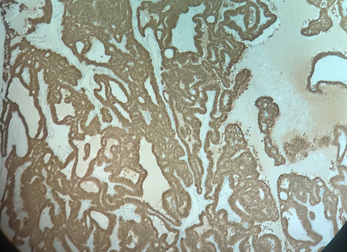 daniel_berney's tweet image. Thyroid H and E and beta-catenin. Decided this young patient needs a colonoscopy.
