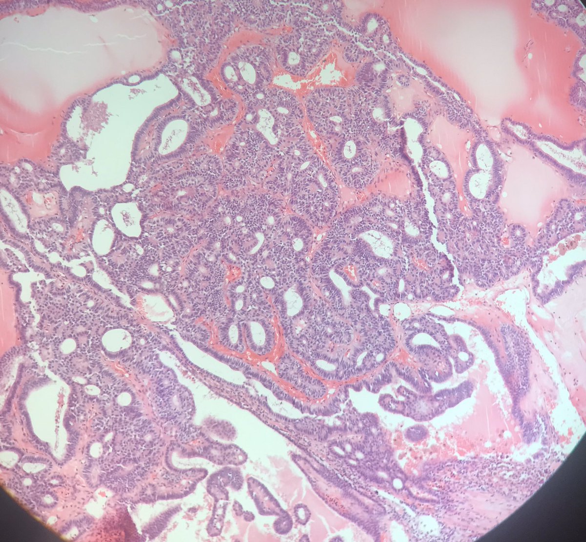 daniel_berney's tweet image. Thyroid H and E and beta-catenin. Decided this young patient needs a colonoscopy.