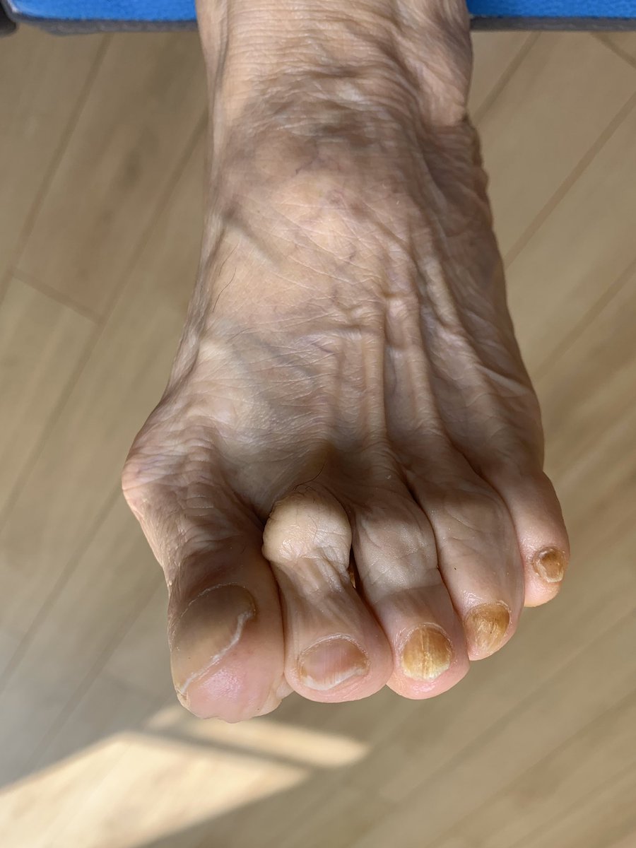 Tırnak mantarı tedavisi 

İletişim WP : 0530 181 6038

Podoist Ayak Bakım Merkezi 

Adres : Cevizli mah. Bağdat cad. Turanlı Plaza No.511 Kat.2 Daire.4 Cevizli/Maltepe