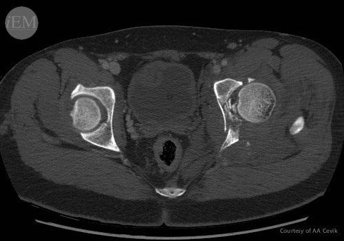 iem_student's tweet photo. "Lower Extremity Injuries" by Ayse Ece Akceylan
#FOAMed #emergencymedicine #ICON360 #iEMstudent #ED #MedEd #medicalstudent #clerkship #EmergencyDepartment #Fracture #Disclocation #orthopedics #Pain #Hip #Knee #Ankle

Read full text: https://t.co/eeSUSdMvWU https://t.co/uFJqlzFHWe