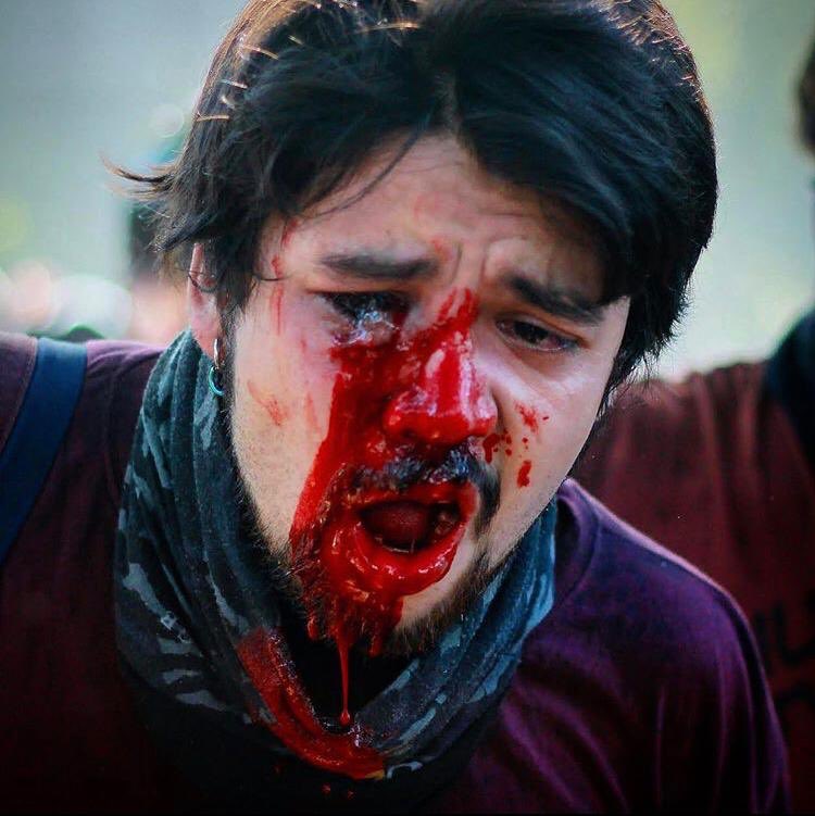 rodrigosepu's tweet photo. Historia terrible. Quien aparece en la foto es cuñado de un amigo y periodista de Mega @MarceloJade . 
Se llama Diego Antonio Leppez Miranda. Caminaba al paradero para llegar a su casa, venía del trabajo y le llegó un proyectil en el rostro. Resultado: PERDIDA TOTAL DEL OJO. https://t.co/HyGqQwA78t