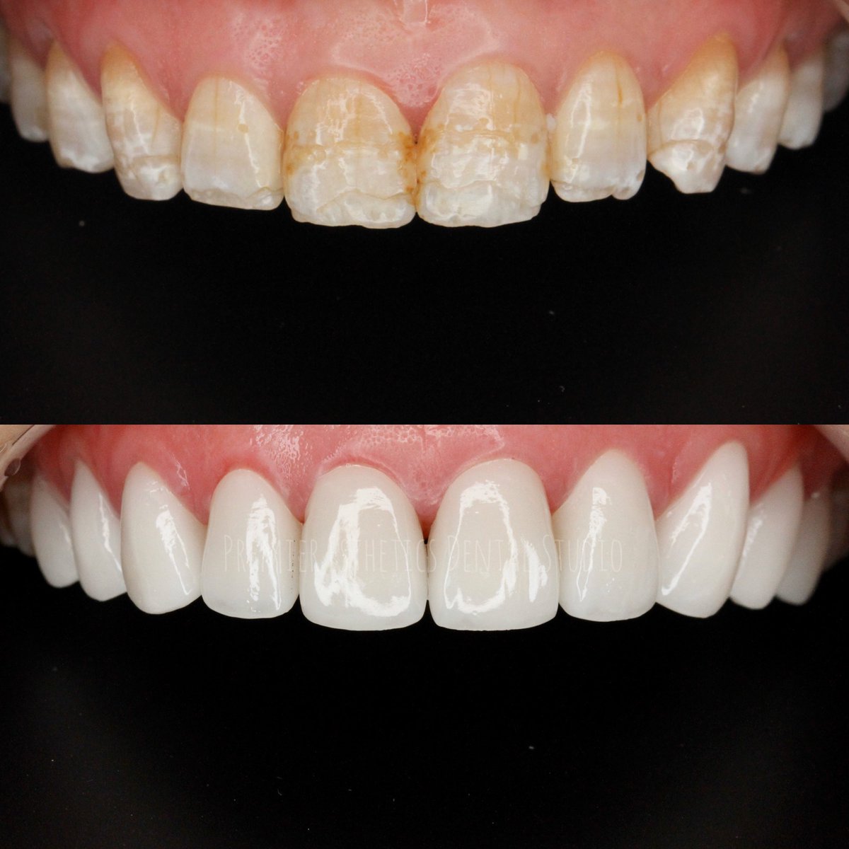 Таны шүд үнэхээр бүрээс хийх заалттай бол зүгээр л шүдээ сэргээ. Өөртөө итгэлтэй инээ хуучин шүдээ март.