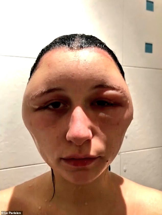 Как убрать отек с лица после удара. Кпк быстро убрать стняе пож гдазои. Как убрать отек с лица после удара. Как быстро избавиться от синяка. Синяки после ринопластики.