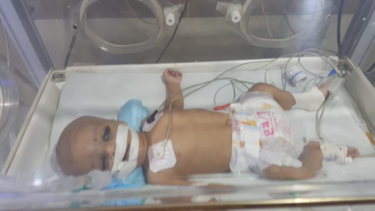 cameramayn's tweet photo. Location: Malir Saudabad Tasleem Hospital, Karachi
Patient Age 1.5 months
Name: Abiyan Asif
TOTAL AMOUNT REQUIRED: PKR 22,050 as of now

if you're willing to help as much as you can, dm me for the account details

RETWEET PLEASE. THE NEXT 72 HOURS ARE VERY CRITICAL. https://t.co/Hv7AeoZ2OJ