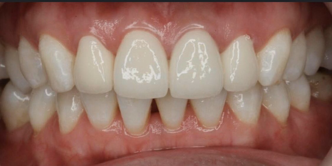 Металл шаазан бүрээсийг циркон бүрээсээр сэргээсэн байдал.