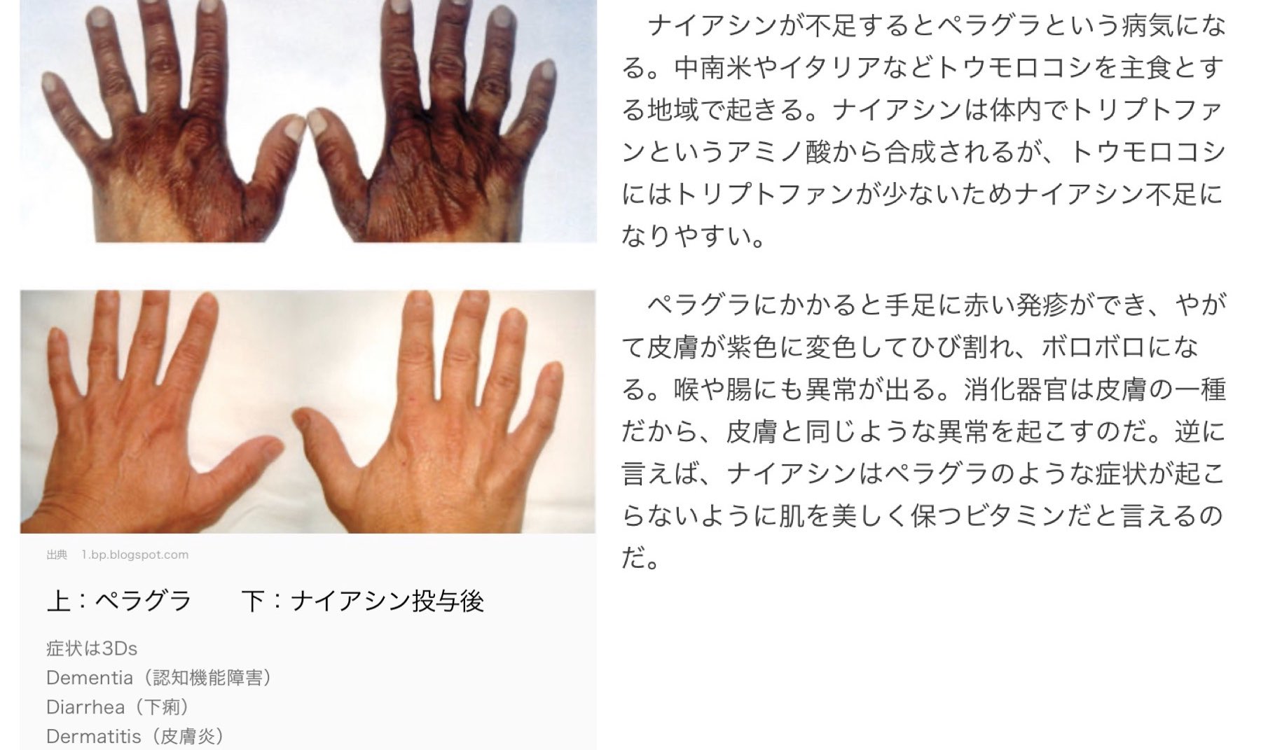 ぱにたん 美容のためにサプリ10種類くらい色々飲んでてぶっちゃけあまり効果感じなかったけれど 若返りの ビタミンとして注目されてるナイアシンこれヤバイかった ナイアシンはビタミンb群の一つで不足するとペラグラといった皮膚病にかかる ペラグラの ぱにたん 美容のためにサプリ10種類くらい色々飲んでてぶっちゃけあまり効果感じなかったけれど 若返りの ビタミンとして注目されてるナイアシンこれヤバイかった ナイアシンはビタミンb群の一つで不足するとペラグラといった皮膚病にかかる ペラグラの