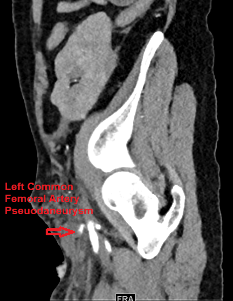 NshRadiology's tweet photo. A #multiloculated left common femoral #artery #pseudoaneurysm treated by #Thrombin injection. The patient's left groin was swollen and tense. #Ultrasound was more informative than #CTA in this case #IRad #Intervention #Radiology #Makkah https://t.co/Atd2WwZ3a3