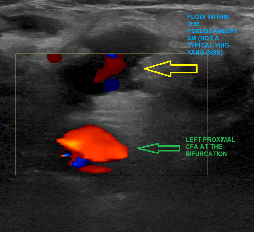 NshRadiology's tweet photo. A #multiloculated left common femoral #artery #pseudoaneurysm treated by #Thrombin injection. The patient's left groin was swollen and tense. #Ultrasound was more informative than #CTA in this case #IRad #Intervention #Radiology #Makkah https://t.co/Atd2WwZ3a3