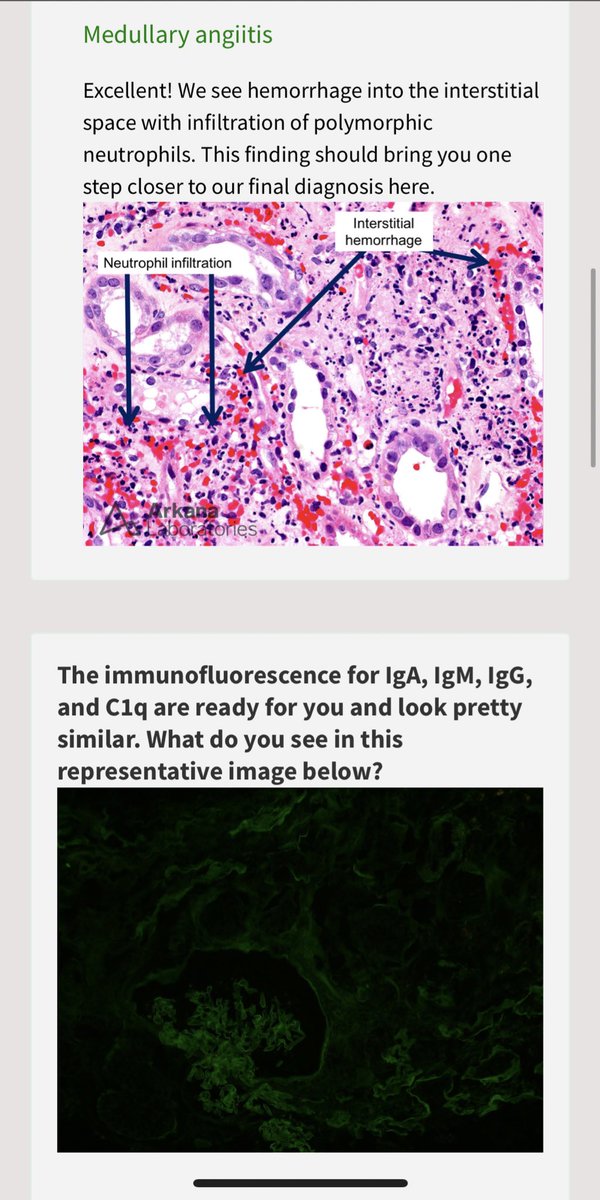 Neph_SIM's tweet photo. A case of rapidly progressive glomerulonephritis #RPGN 

https://t.co/DOeCyO7HZP

#FOAMed #KidneyPath https://t.co/UmQQAGL4Xf