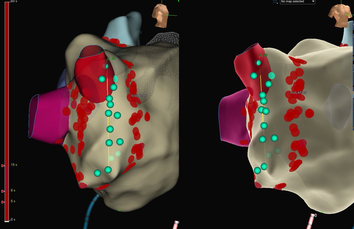 NathanSegerson's tweet photo. A case reminding us to always map phrenic nerve when encircling RUPV. Phrenic capture spanned 6cm from well out the vein to TS puncture. Very wide encirclement still isolates. https://t.co/Nub8LjULgd
