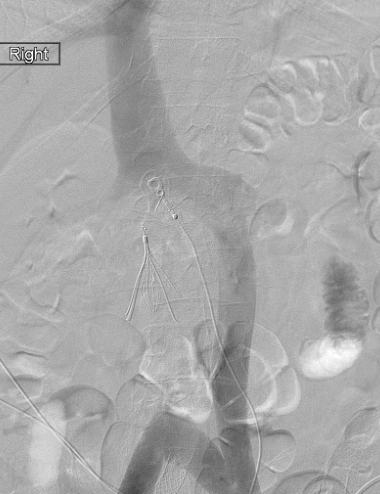 Pt presents w/ major PE despite prior IVC filter 5 yrs ago @ OSH. Interesting venogram yielded many AH-HA!!'s. Congenital double IVC variant w/ rare CIV interconnection vs impressive collateral vein development (ascending lumbar v). (no priors to know for sure) @SIRRFS @SIR_ECS