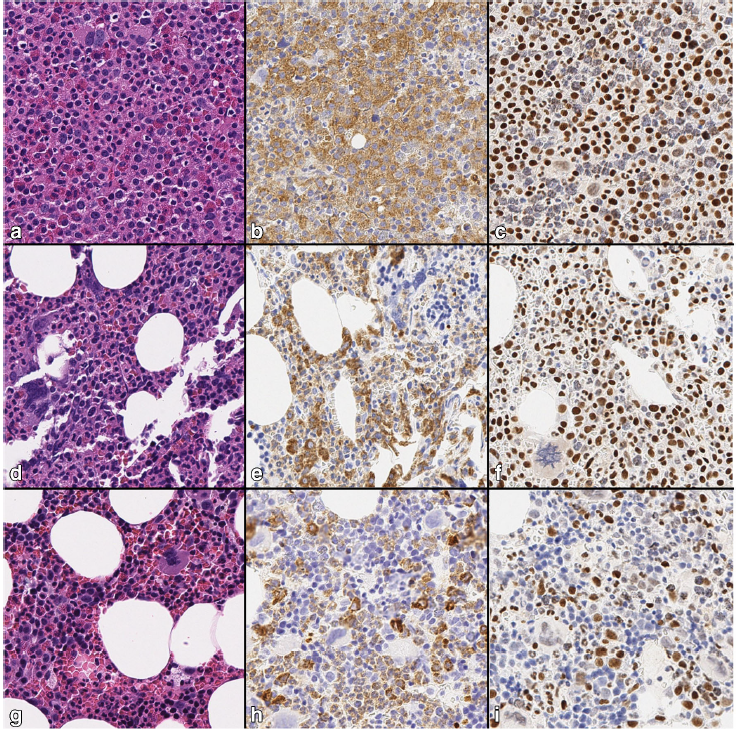 KonstantinosLin's tweet photo. Our new work just published. We explored the utility of ERG IHC as a nuclear marker in hematolymphoid neoplasms in relation to more traditional markers. #pathology #hemepath #oncology https://t.co/JOxZhYlgBs
