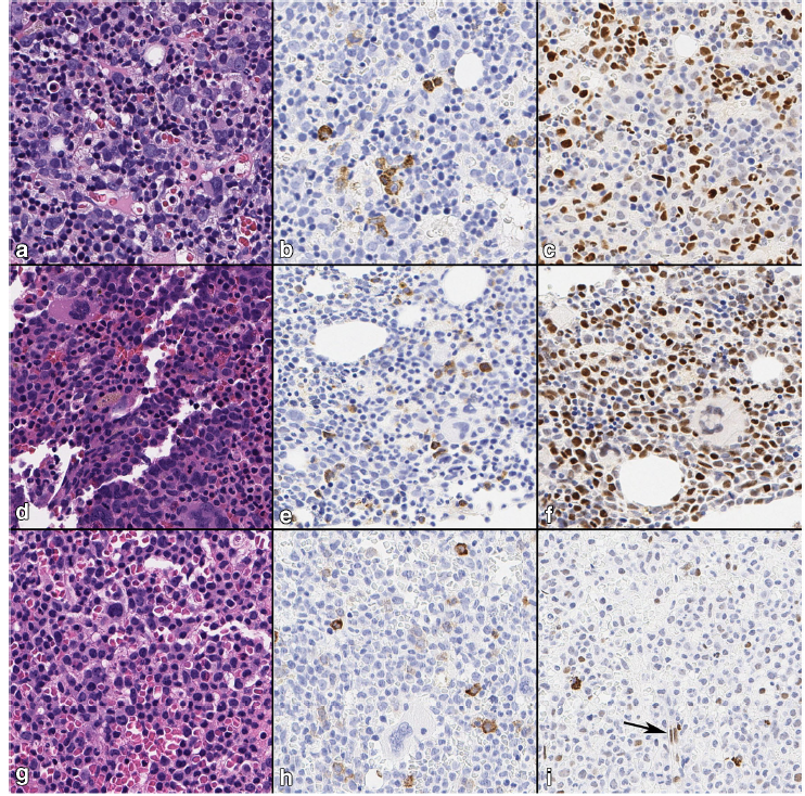 KonstantinosLin's tweet photo. Our new work just published. We explored the utility of ERG IHC as a nuclear marker in hematolymphoid neoplasms in relation to more traditional markers. #pathology #hemepath #oncology https://t.co/JOxZhYlgBs