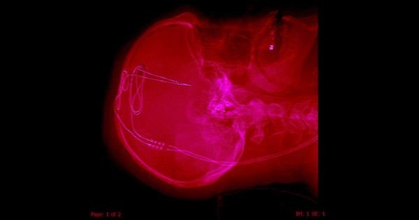 thebraindriver's tweet image. Doctors Are Using Human #BrainImplants to Fight Drug #Addiction #compulsion @futurism @TheBrainDriver #tDCS #BrainPower #Creativity #BrainStimulation #focus #PeakPerformance thebraindriver.com 
flip.it/zRdk54