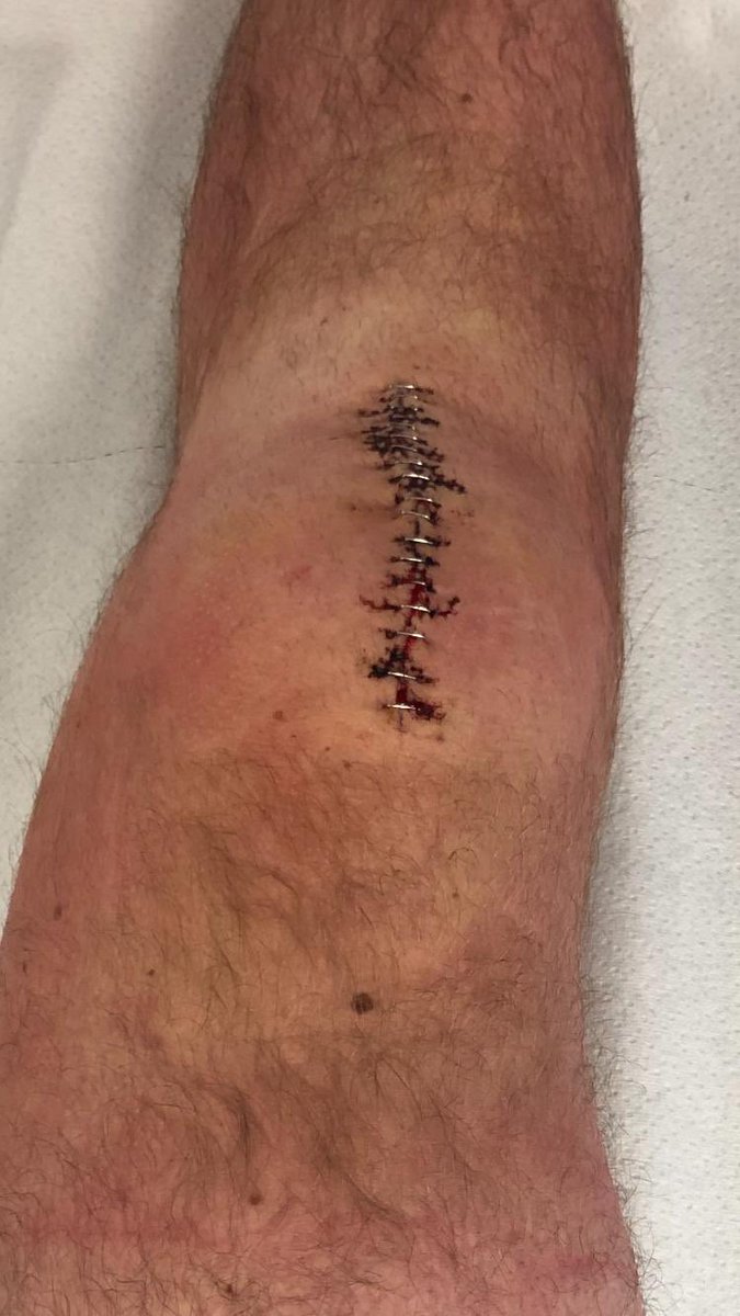 The Cobras (@cdcobras) on Twitter photo After cobras legend <a href="/willpearson4/">Will Pearson</a> suffered a terrible injury which could potentially prevent him from playing again at the age of 25. This Sunday, a cobras Xl will take on @CDFC1977 to help support and raise funds towards his recovery. #PrayForWilly #ClubTropicana #LetsBooze 💜🐍 After cobras legend <a href="/willpearson4/">Will Pearson</a> suffered a terrible injury which could potentially prevent him from playing again at the age of 25. This Sunday, a cobras Xl will take on @CDFC1977 to help support and raise funds towards his recovery. #PrayForWilly #ClubTropicana #LetsBooze 💜🐍