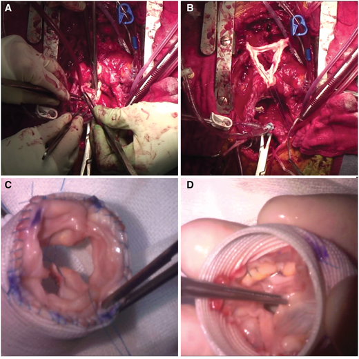 EACTS_Journals's tweet image. #ICVTS #CaseReport
Pulmonary root inclusion in #Dacron graft, modification of the #Ross procedure by Horikoshi et al.   bit.ly/374e4jR