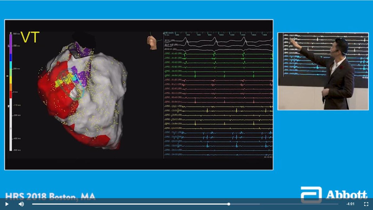 Abbott Cardiovascular (@abbottcardio) on Twitter photo #Epeeps: looking for a method other than voltage to evaluate the substrate for arrhythmic VT after infarct or in non-ischemic ideologies?
This video by <a href="/DrRoderickTung/">Roderick Tung</a> shows how #HDGrid can help.
bit.ly/2NUz4lo
Important Safety Info: bit.ly/2r6YQtC #Epeeps: looking for a method other than voltage to evaluate the substrate for arrhythmic VT after infarct or in non-ischemic ideologies?
This video by <a href="/DrRoderickTung/">Roderick Tung</a> shows how #HDGrid can help.
bit.ly/2NUz4lo
Important Safety Info: bit.ly/2r6YQtC
