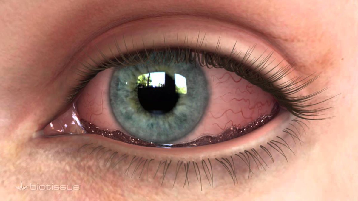 BiotissueOcular's tweet photo. Did you know that Mechanical Dry Eye (also known as Conjunctivochalasis) is the most undiagnosed type of Dry Eye Disease? Find out why - https://t.co/ZRZMvJiDJU
#BioTissue #dryeye #mechanicaldryeye #Conjunctivochalasis #Ophthalmology https://t.co/rTupm5gHOr