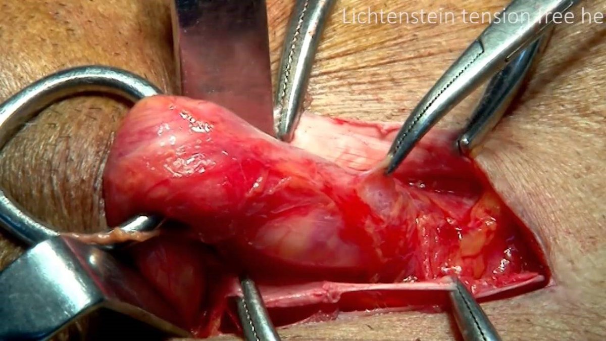 EAST_TRAUMA's tweet photo. We’ve come a long way in hernia repair since Dr. Lichtenstein’s description in 1989. Review the original &amp; other landmark inguinal hernia articles here: https://t.co/UPk5nY5qbX

#hernia #surgtweeting #EASTEGS #EmergSurg #LandmarkPapers https://t.co/Bueq86uzkz
