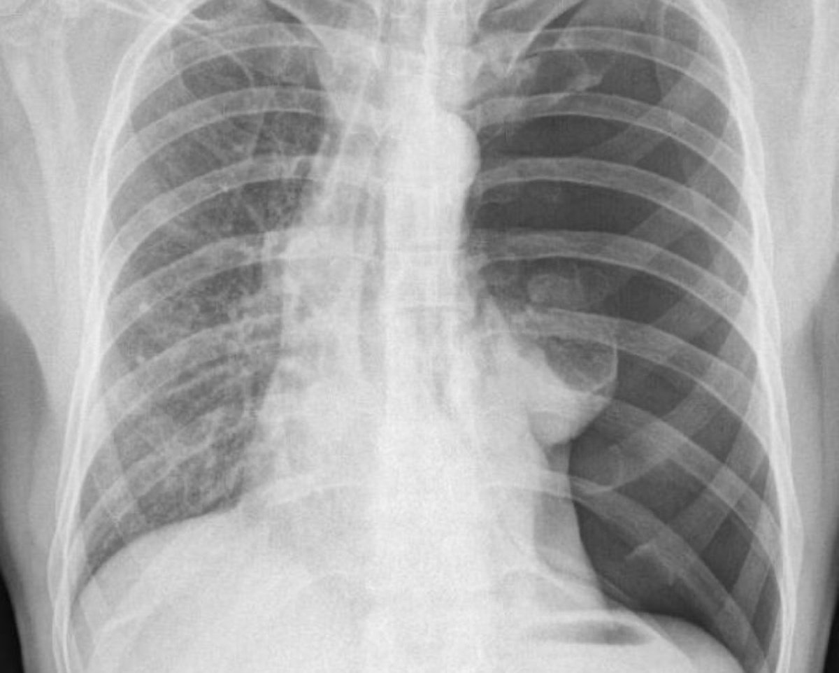 eurjther's tweet photo. A New Predictor for Patients with Cardiac Implantable Electronic Device in Iatrogenic Pneumothorax: The Clavicle Length Index https://t.co/2b9L1FCUuU @TKDsosyal #cardiology #cardiotwitter #pneumothorax #cardiacdevice #claviclelength #medicine #medtwitter https://t.co/9Olbel7hzW