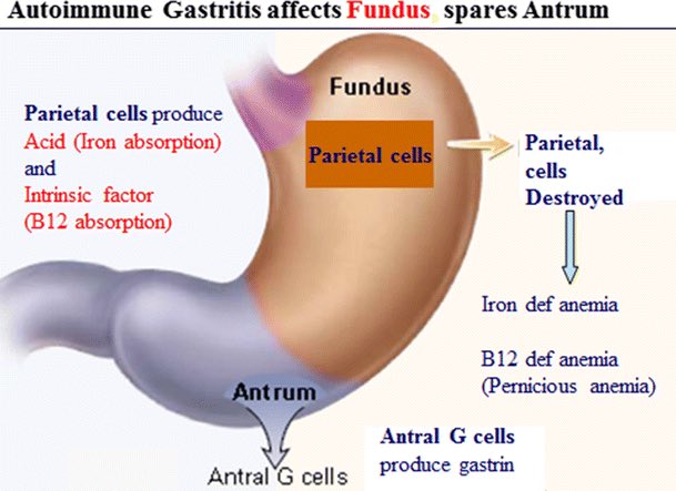 TeamFrieda's tweet photo. Freida’s work showed that pernicious armenia is the lack of vitamin B12 which can be reversed with raw liver #GHSMatildaEffect https://t.co/RJNstjmZsc