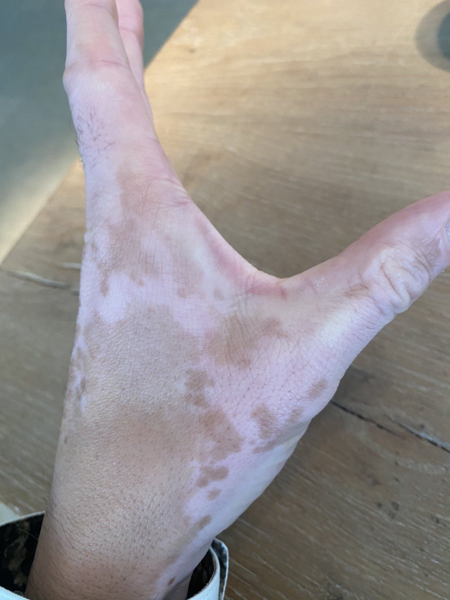 saynotovitiligo's tweet image. #repigmentation #saynotovitiligo