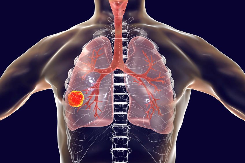 STS_CTsurgery's tweet photo. Are we doing enough? Many elderly #patients w/ early stage lung cancer do not receive treatment; but new research from @StanfordMed published in @annalsthorsurg shows that surgery for these patients may significantly improve their chances of living longer. https://t.co/ZQAHO3PPik https://t.co/6W2c7Mg6UU