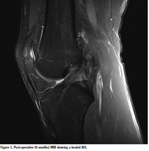 SurgicalTechSTI's tweet photo. Anterior Cruciate Ligament Repair
in a Professional Soccer Player Using
Internal Brace Ligament AugmentationGRAEME P HOPPER, MBCHB, MSC, MRCS
UNIVERSITY OF GLASGOW, GLASGOW, SCOTLAND
https://t.co/Lv4ZyBJrUR https://t.co/172SicRL3e