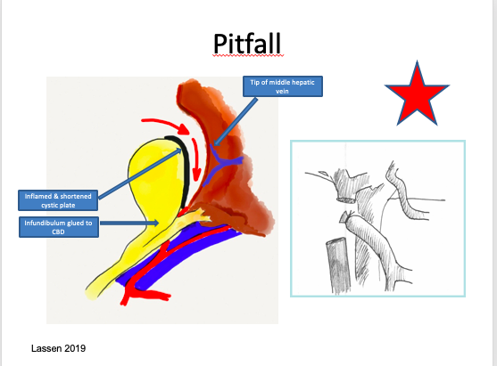 xtofero's tweet photo. @MISIRG1 @salo75 @VesaliusCX @Cirbosque @hpbsurgeon1 @OscarGuevaraHPB @HenryPittMD @ProfW_edinsurg @KevinElHayekMD @mj_pucci @FilippoLandi_ @juliomayol @DissanaikeMD Injury mechanism in fundus-down cholecystectomy in severly (repeatedly) inflamed gallbladder. https://t.co/Ie8u7XBmQE