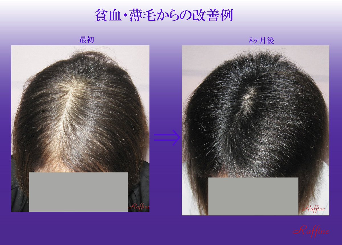 松田映子 女性の貧血による薄毛白髪が多いです しっかり栄養補給しながら再生復活しています 詳しくはラ フィーネへ 薄毛白髪改善