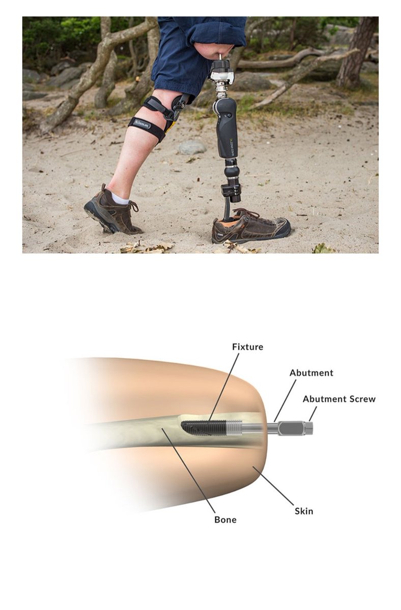 JosephHsuMD's tweet image. Big day yesterday @AtriumHealth!  Thanks to mentorship from Rickard Branemark &amp;amp; @MilOrtho surgeons John Forsberg &amp;amp; Kyle Potter, we did our first #osseointegration #amputation #amputee case yesterday.  The ability to directly connect a prosthesis to the skeleton is life-changing.