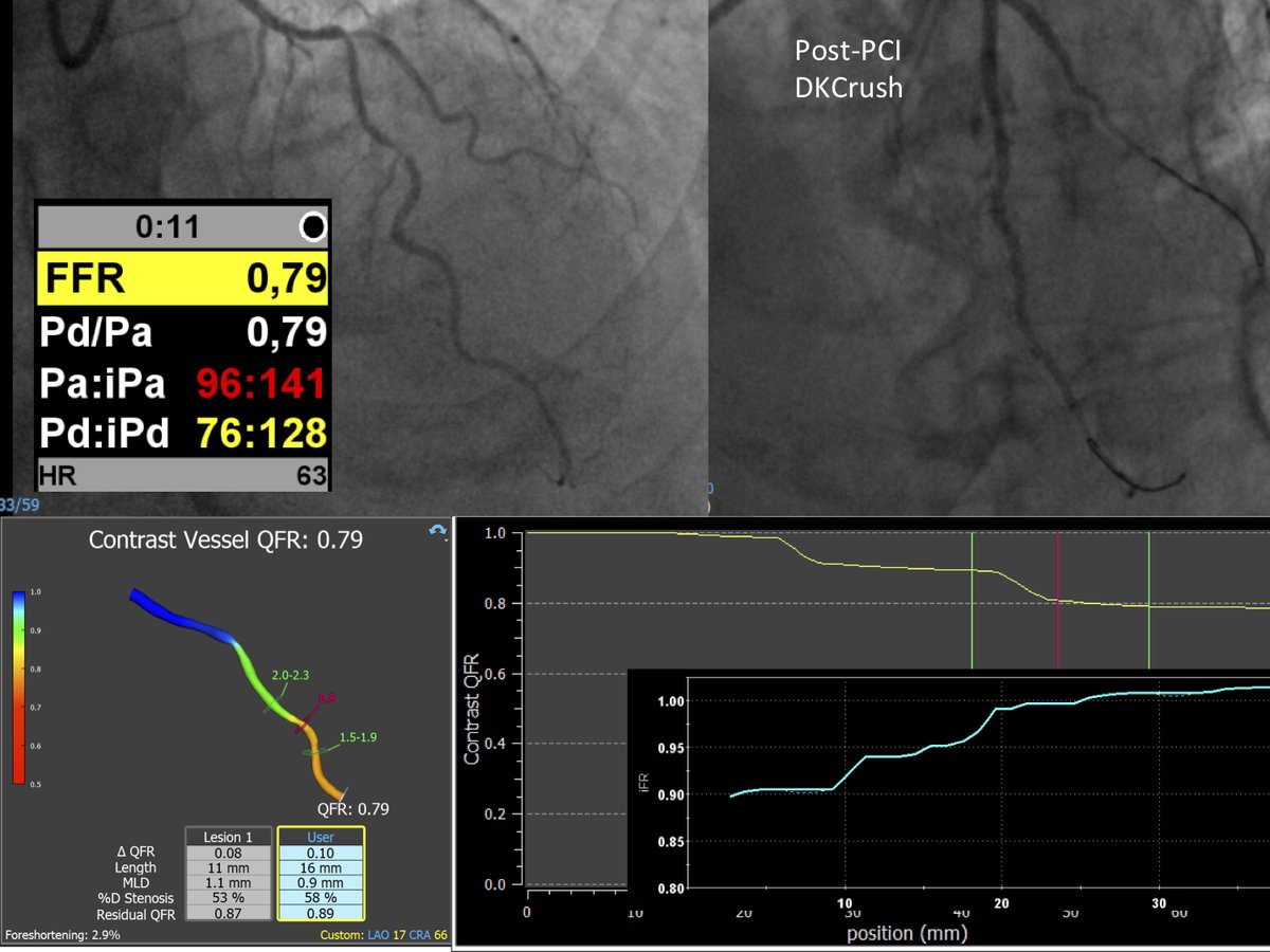 #QFR PCI guidance in serial stenosis of LAD. Excellent correlation with FFR and iFR pullback. <a href="/riojasalud/">Riojasalud.es</a> @perico_keppa <a href="/INC_CathLab/">INC Cath Lab</a> <a href="/afm_cardio/">Antonio FM</a> <a href="/torre_alvaro/">Alvaro Torre Garcia</a> @egutibanes <a href="/fer_iver/">Fernando Rivero</a> <a href="/MarioMarsad/">marsad</a>