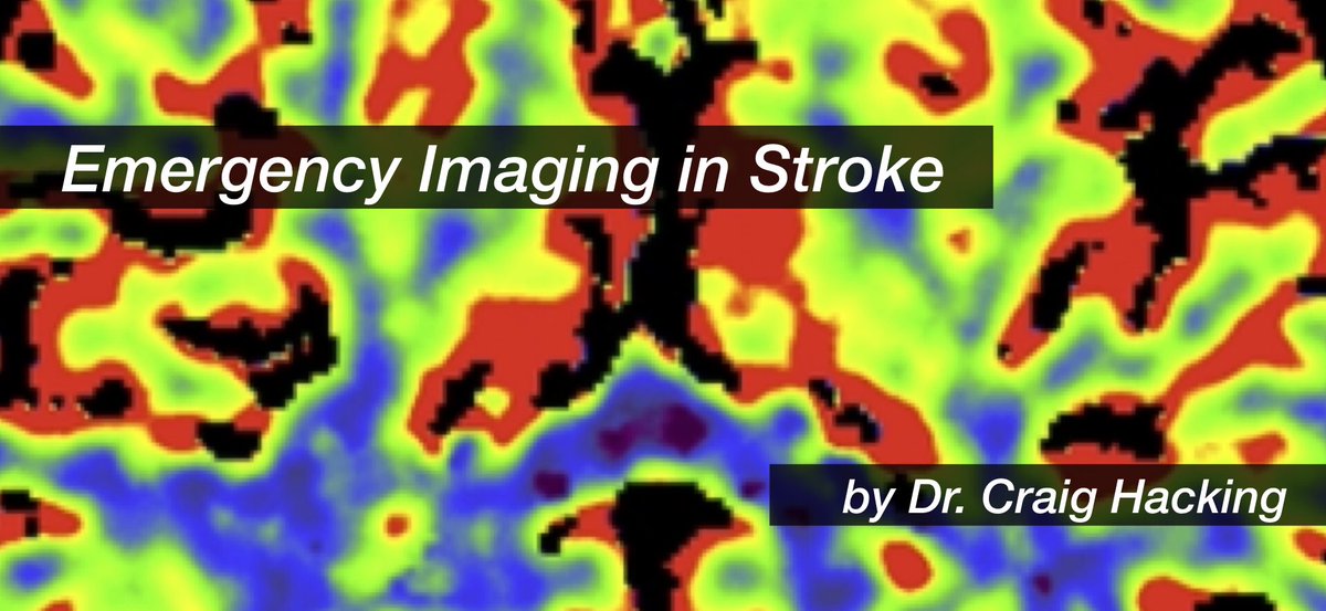 Radiopaedia's tweet image. Did you miss @drcraighacking&apos;s recent webinar on emergency stroke imaging? Catch it now for free on Radiopaedia. Includes six review questions and access to cases and slides. radiopaedia.org/courses/emerge… #foamed #foamrad