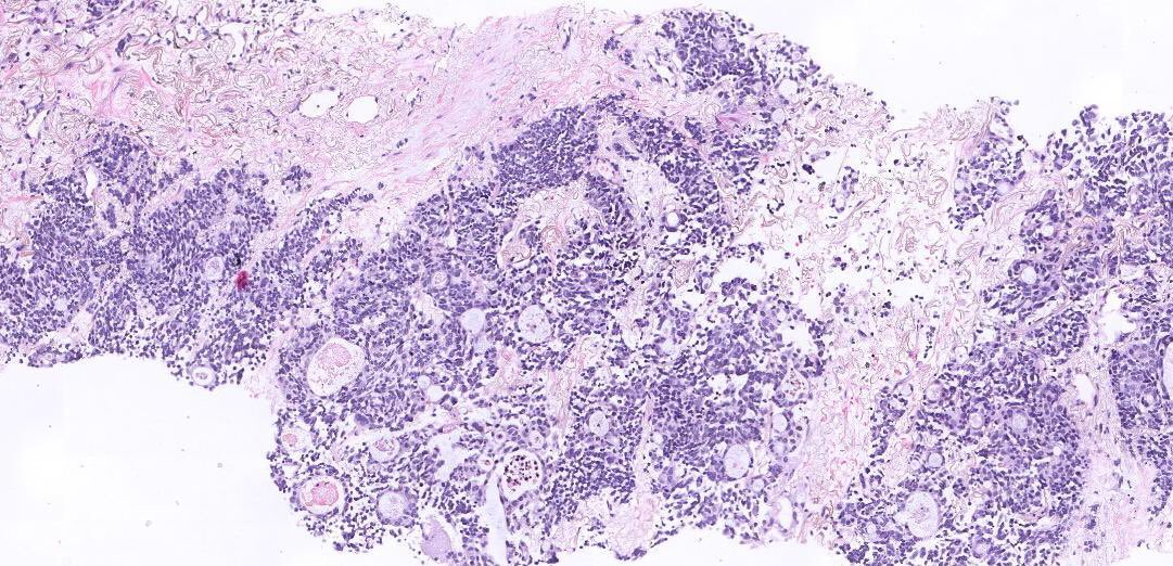 lara_pijuan's tweet photo. Dear tweeples, do you think this lung tumor is a Combined Small Cell Carcinoma 🤨? Previous breast neoplasm (ductal carcinoma 8y ago). Female middle age, smoker. Lung Upper Right lobe mass wt mediastinal lymph nodes. #pulmpath #challengeforme #SCLC #Lungcancer https://t.co/BViAXaDLhW