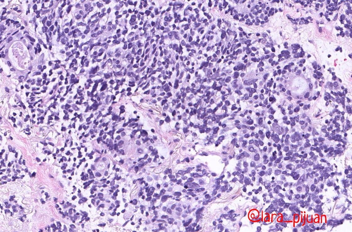 lara_pijuan's tweet photo. Dear tweeples, do you think this lung tumor is a Combined Small Cell Carcinoma 🤨? Previous breast neoplasm (ductal carcinoma 8y ago). Female middle age, smoker. Lung Upper Right lobe mass wt mediastinal lymph nodes. #pulmpath #challengeforme #SCLC #Lungcancer https://t.co/BViAXaDLhW