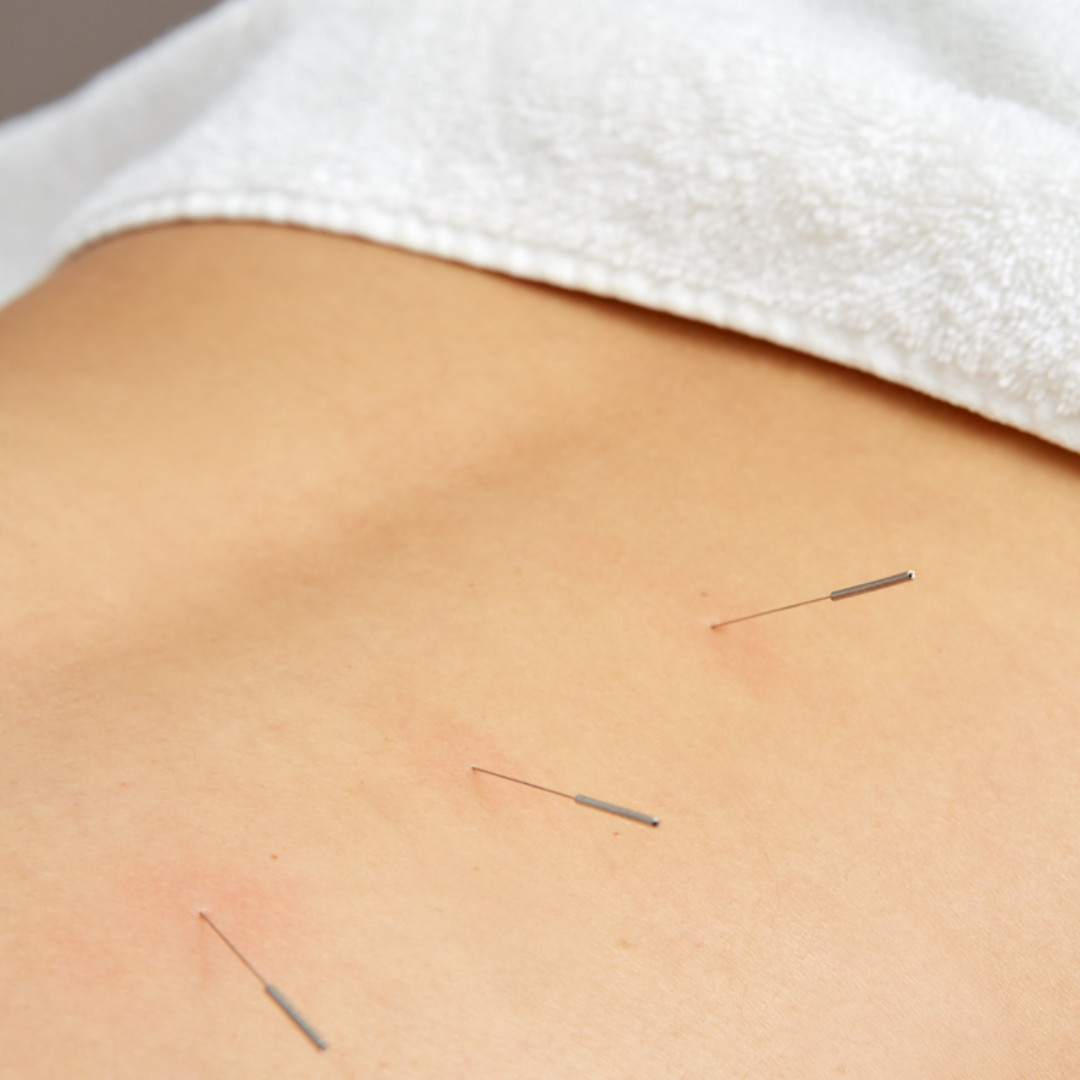 Clknwell_Chiro's tweet image. All our acupuncturists are all registered with the British Acupuncture Council
The aim is to tap into your body’s own healing response and to restore physical, emotional and mental equilibrium.