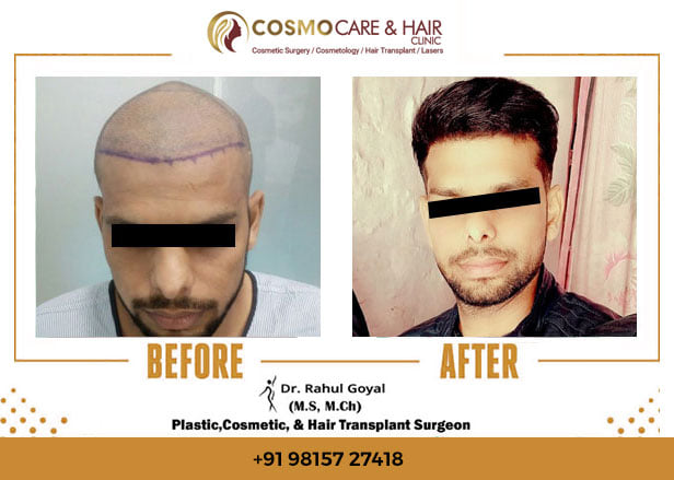 Cosmetic Plastic Surgery Clinic Chandigarh  Cosmo Care  Hair Clinic