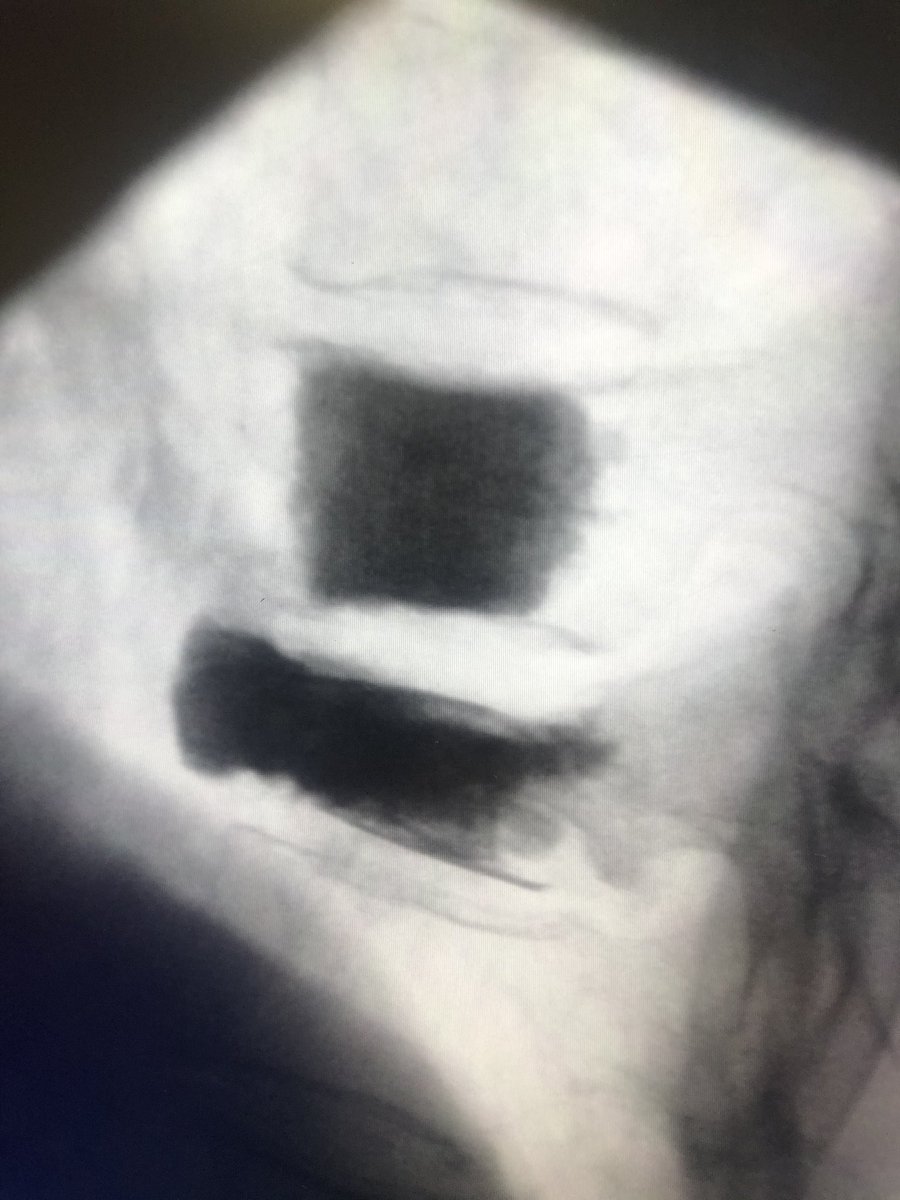 dougbeall's tweet photo. Can’t do this with a balloon or Vertebroplasty. #SpineJack had been a great addition to the armamentarium
@SIRspecialists @The_ASSR @ASIPP @ASBMR @RSNA https://t.co/w9Sz3dL5Po