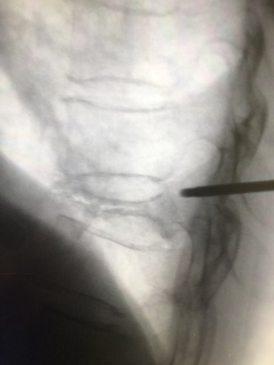 dougbeall's tweet photo. Can’t do this with a balloon or Vertebroplasty. #SpineJack had been a great addition to the armamentarium
@SIRspecialists @The_ASSR @ASIPP @ASBMR @RSNA https://t.co/w9Sz3dL5Po